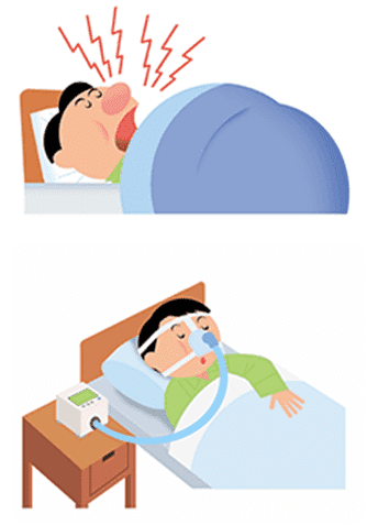 睡眠時無呼吸症候群